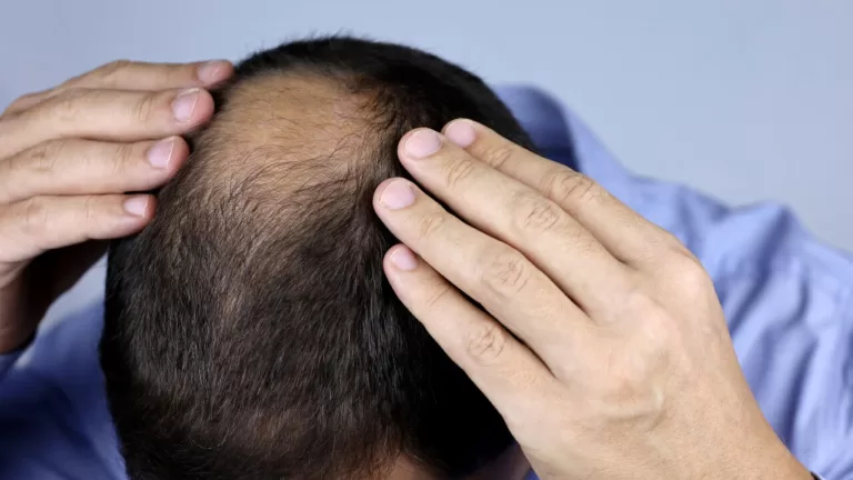 Understanding Alopecia Hair Loss: Causes and Treatment