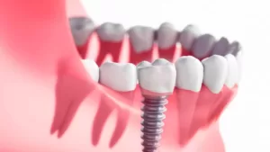 How To Treat Dental Implant Infection